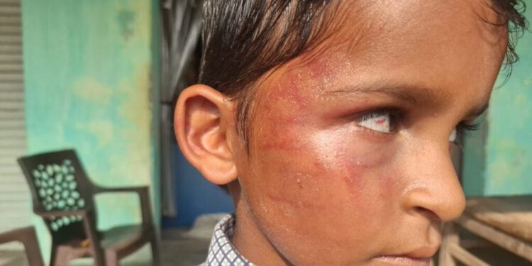 बलरामपुर: प्राथमिक स्कूल में शिक्षक द्वारा दूसरी कक्षा के छात्र की बेरहमी से पिटाई, आंख में उतरा खून; प्रधान पाठक निलंबित..